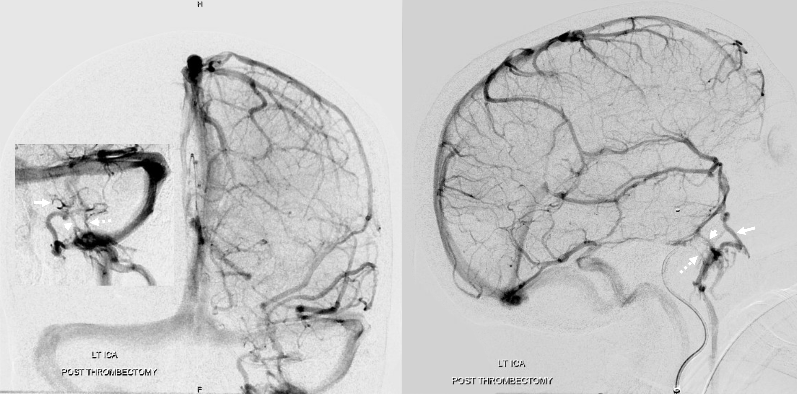 Cavernous Sinus | neuroangio.org